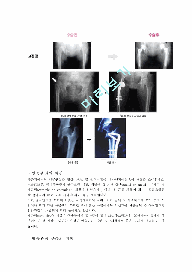 [의학,약학][의학] 고관절인공관절전치환술[Total Hip Replacement]에 관해   (7 )